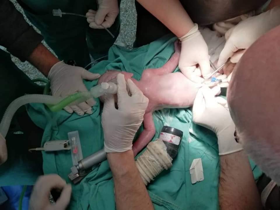  تمكن أطباء في الشمال السوري من إنقاذ جنين من رحم أمه التي توفيت في حادث سير على أوتوستراد باب الهوى في وقت متأخر من ليل أمس الأربعاء.