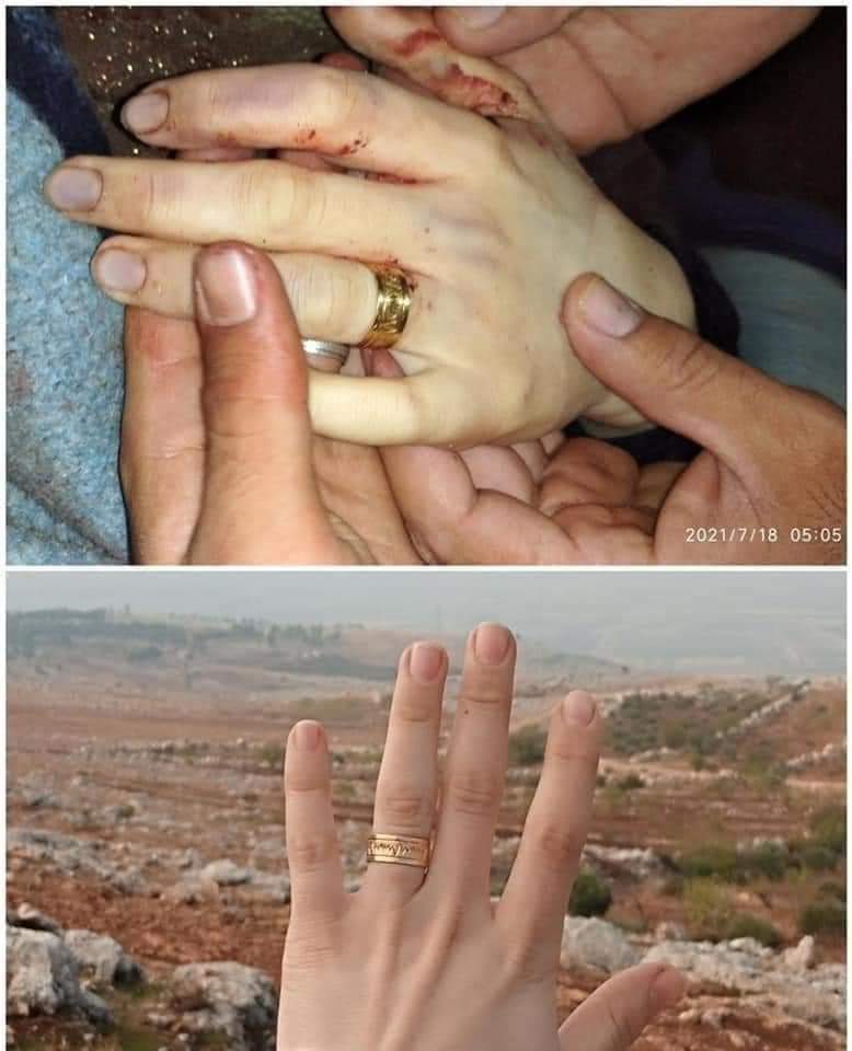 تسببت صواريخ مليشيا نظام الأسد وروسيا بإنهاء فرحة عروسين في إدلب، وتحويل قصة حبهما إلى مأساة، بعد أن فارقت العروس الحياة عقب أيام قليلة من زواجها.