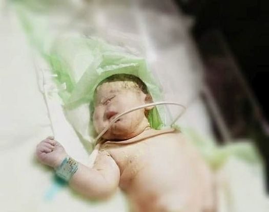 سجلت مدينة عفرين بريف حلب ليلة أمس حالة ولادة نادرة لطفل بعين واحدة فقط على مستوى الشرق الأوسط ودول العالم.